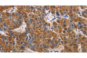 Immunohistochemistry of paraffin-embedded Human liver cancer tissue using APLNR Polyclonal Antibody at dilution 1:50 (Apelin Receptor Antikörper)