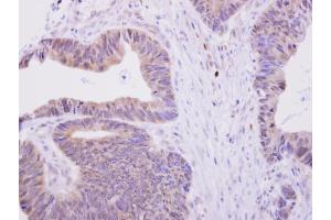 IHC-P Image H6PD antibody [N2N3] detects H6PD protein at cytoplasm on human colon carcinoma by immunohistochemical analysis. (Glucose-6-Phosphate Dehydrogenase Antikörper)