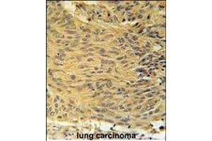 LCLT1 Antibody (C-term) (ABIN651910 and ABIN2840449) immunohistochemistry analysis in formalin fixed and paraffin embedded human lung carcinoma followed by peroxidase conjugation of the secondary antibody and DAB staining. (LCLAT1 Antikörper  (AA 296-324))