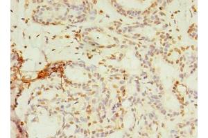 Immunohistochemistry of paraffin-embedded human breast cancer using ABIN7142992 at dilution of 1:100 (SMPDL3A Antikörper  (AA 51-350))