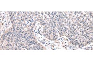Immunohistochemistry of paraffin-embedded Human lung cancer tissue using ZNF239 Polyclonal Antibody at dilution of 1:25(x200) (ZNF239 Antikörper)