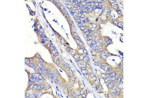 Immunohistochemistry of paraffin-embedded human colon carcinoma using Fatty Acid Synthase (FASN) Rabbit mAb  at dilution of 1:100 (40x lens). (Fatty Acid Synthase Antikörper)