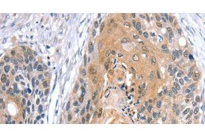 Immunohistochemistry of paraffin-embedded Human esophagus cancer using GNAT3 Polyclonal Antibody at dilution of 1:35 (GNAT3 Antikörper)