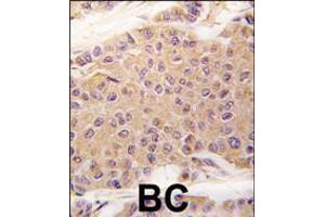 Formalin-fixed and paraffin-embedded human breast carcinoma tissue reacted with TGFB2 antibody , which was peroxidase-conjugated to the secondary antibody, followed by DAB staining. (TGFB2 Antikörper  (C-Term))