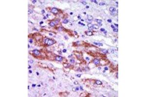 Formalin-fixed and paraffin-embedded human cancer tissue reacted with the primary antibody, which was peroxidase-conjugated to the secondary antibody, followed by DAB staining. (Casein Kinase 1 delta Antikörper  (C-Term))