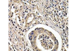 Immunohistochemistry of paraffin-embedded Human gastric cancer using ARRB2 Polyclonal Antibody at dilution of 1:200 (40x lens). (Arrestin 3 Antikörper)