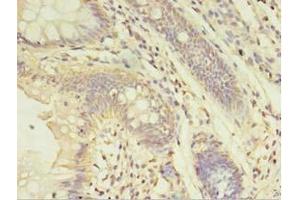 Immunohistochemistry of paraffin-embedded human colon cancer using ABIN7143952 at dilution of 1:100 (ABHD14A Antikörper  (AA 56-258))