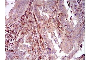 Immunohistochemical analysis of paraffin-embedded endometrial cancer tissues using MAPK14 mouse mAb with DAB staining. (MAPK14 Antikörper  (AA 299-360))