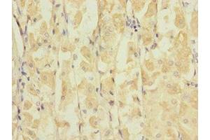 Immunohistochemistry of paraffin-embedded human gastric cancer using ABIN7153977 at dilution of 1:100 (GRIK3 Antikörper  (AA 32-240))