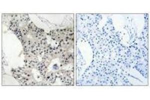 Immunohistochemistry analysis of paraffin-embedded human breast carcinoma tissue using BAGE4 antibody. (BAGE4 Antikörper)