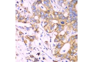 Immunohistochemistry of paraffin-embedded human liver cancer using RPS3A Antibody (ABIN5973489) at dilution of 1/100 (40x lens). (RPS3A Antikörper)
