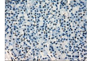 Immunohistochemical staining of paraffin-embedded Adenocarcinoma of colon tissue using anti-SATB1mouse monoclonal antibody. (SATB1 Antikörper)