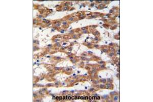 Formalin-fixed and paraffin-embedded human hepatocarcinoma tissue reacted with PHB antibody , which was peroxidase-conjugated to the secondary antibody, followed by DAB staining. (Prohibitin Antikörper  (AA 89-117))