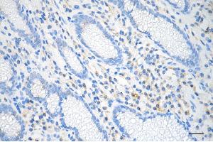 Immunohistochemistry was performed on paraffin-embedded human gastric carcinoma using LMAN1 antibody (ABIN7799245), 1:200).