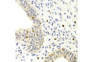 Immunohistochemistry of paraffin-embedded human metrocarcinoma using GEMIN2 antibody at dilution of 1:200 (400x lens). (SIP1 Antikörper)