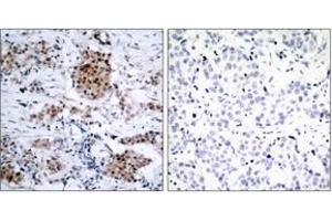 Immunohistochemistry analysis of paraffin-embedded human breast carcinoma, using Estrogen Receptor-alpha (Phospho-Ser167) Antibody. (Estrogen Receptor alpha Antikörper  (pSer167))