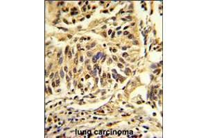 Formalin-fixed and paraffin-embedded human lung carcinoma reacted with CEBPB Antibody , which was peroxidase-conjugated to the secondary antibody, followed by DAB staining. (CEBPB Antikörper  (C-Term))
