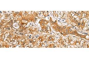 Immunohistochemistry of paraffin-embedded Human liver cancer tissue using RIDA Polyclonal Antibody at dilution of 1:65(x200) (HRSP12 Antikörper)