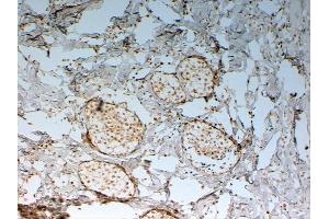 ABIN185029 (2 µg/mL) staining of paraffin embedded Human Breast cancer. (FOXC2 Antikörper  (C-Term))