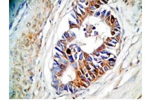 Human stomach cancer tissue was stained by rabbit Anti-Spexin prepro (73-116)  (H) Antiserum (Spexin Antikörper  (Preproprotein))