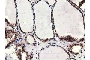 Immunohistochemical staining of paraffin-embedded Carcinoma of Human kidney tissue using anti-CBWD1 mouse monoclonal antibody. (CBWD1 Antikörper)