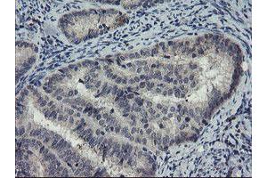 Immunohistochemical staining of paraffin-embedded Adenocarcinoma of Human endometrium tissue using anti-DOK7 mouse monoclonal antibody. (DOK7 Antikörper)