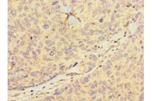 Immunohistochemistry of paraffin-embedded human ovarian cancer using ABIN7155399 at dilution of 1:100 (HIST1H2BD Antikörper  (AA 2-57))