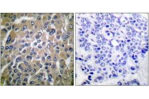 Immunohistochemistry analysis of paraffin-embedded human breast carcinoma tissue, using hCG beta Antibody. (HCG beta Antikörper  (AA 101-150))