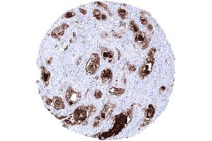 Squamous cell carcinoma showing strong KLK7 staining in areas of keratinization (Kallikrein 7 Antikörper)