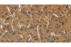 Immunohistochemistry of paraffin-embedded Human liver cancer tissue using CYP17A1 Polyclonal Antibody at dilution 1:30 (CYP17A1 Antikörper)