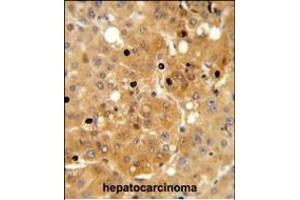 PRK Antibody (ABIN652306 and ABIN2841396) IHC analysis in formalin fixed and paraffin embedded human hepatocarcinoma followed by peroxidase conjugation of the secondary antibody and DAB staining. (PRKAA1 Antikörper)