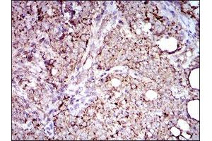Immunohistochemical analysis of paraffin-embedded cervical cancer tissues using ALDH2 mouse mAb with DAB staining. (ALDH2 Antikörper  (AA 317-517))