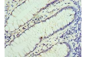 Immunohistochemistry of paraffin-embedded human colon cancer using ABIN7155860 at dilution of 1:100 (VENTX Antikörper  (AA 1-258))