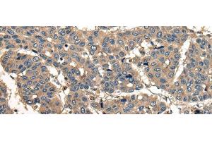 Immunohistochemistry of paraffin-embedded Human liver cancer tissue using CORO1B Polyclonal Antibody at dilution of 1:40(x200) (CORO1B Antikörper)