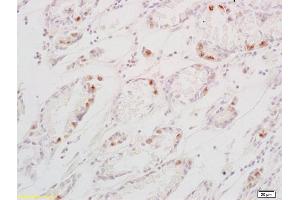 Formalin-fixed and paraffin embedded human gastric carcinoma labeled with Anti-TGF alpha Polyclonal Antibody, Unconjugated (ABIN724415) at 1:200 followed by conjugation to the secondary antibody and DAB staining (TGFA Antikörper  (AA 40-89))
