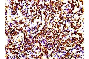 IHC image of ABIN7127297 diluted at 1:100 and staining in paraffin-embedded human lung cancer performed on a Leica BondTM system. (Rekombinanter HIST1H4A Antikörper)