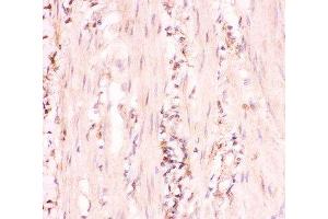 IHC-P: MRP4 antibody testing of human intestinal cancer tissue (ABCC4 Antikörper  (AA 1-370))