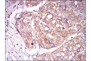 Immunohistochemical staining of human liver cancer tissues with TIE1 monoclonal antibody, clone 8D12B10  at 1:200-1:1000 dilution. (TIE1 Antikörper  (AA 385-607))