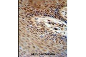 ZNF324B antibody (C-term) (ABIN654564 and ABIN2844270) immunohistochemistry analysis in formalin fixed and paraffin embedded human skin carcinoma followed by peroxidase conjugation of the secondary antibody and DAB staining. (ZNF324B Antikörper  (C-Term))