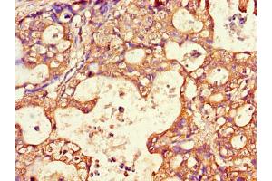 IHC-P analysis of Human Gastric cancer tissue, using AQP antibody (1/100 dilution).