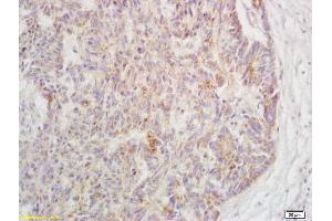 Formalin-fixed and paraffin embedded human rectal carcinoma labeled with Rabbit Anti-Phospho-TAK1(Ser192) Polyclonal Antibody, Unconjugated (ABIN802023) at 1:200 followed by conjugation to the secondary antibody and DAB staining