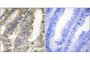 Immunohistochemistry analysis of paraffin-embedded human colon carcinoma tissue, using TNFA Antibody. (TNF alpha Antikörper  (AA 141-190))