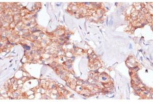 Immunohistochemistry of paraffin-embedded Human breast cancer using TIMM8B Polyclonal Antibody at dilution of 1:100 (40x lens).