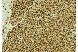 ABIN6269300 at 1/100 staining Human breast cancer tissue by IHC-P. (SMAD3 Antikörper  (C-Term))