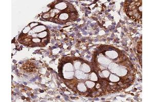 ABIN6266573 at 1/200 staining human colon carcinoma tissue sections by IHC-P. (KRT20 Antikörper  (C-Term))