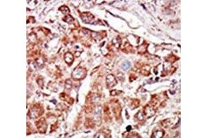 IHC analysis of FFPE human hepatocarcinoma stained with the PKR antibody (EIF2AK2 Antikörper  (AA 11-42))