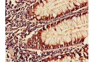 Immunohistochemistry of paraffin-embedded human colon cancer using ABIN7175954 at dilution of 1:100 (YAF2 Antikörper  (AA 1-204))