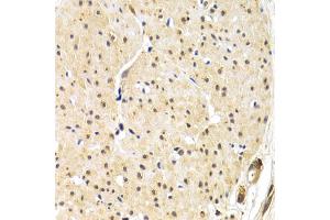Immunohistochemistry of paraffin-embedded human gastric cancer using TERF1 antibody (ABIN6292425) at dilution of 1:200 (40x lens). (TRF1 Antikörper)