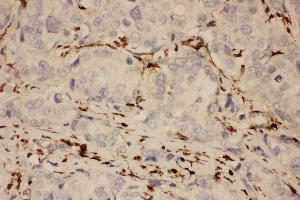 Anti-COX1 Picoband antibody,  IHC(P): Human Mammary Cancer Tissue (PTGS1 Antikörper  (AA 318-599))