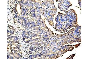 IHC analysis of Galectin 3/LGALS3 using anti Galectin 3/LGALS3 antibody (ABIN6719486). (Galectin 3 Antikörper  (AA 139-250))